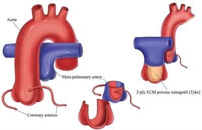 Reconstruction of the Neopulmonary Root After Coronary Button Harvest for Arterial Switch Operation Using 2-ply Extracellular Matrix (Tyke): A Post-Implant Histology